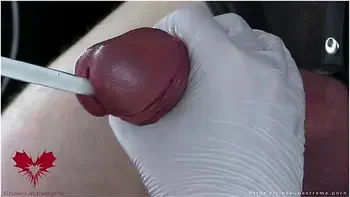 Perfect Extraction Of Sperm Directly From The Urethra. Close-up Of The Glass Straw Sounding