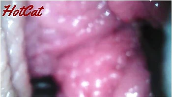 Endoscopic Vaginal Observation